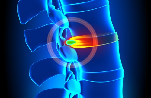 hernias discales