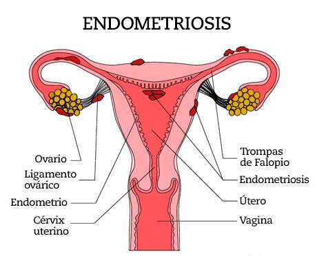 endometriosis