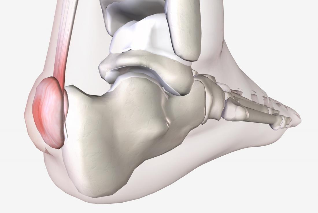 sindrome o enfermedad de haglund